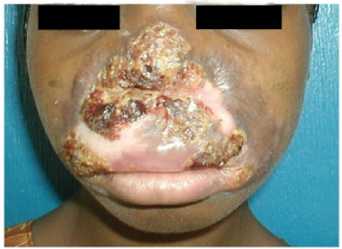 Tuberkulosis Orifisium